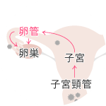 なんでクラミジアで不妊症に?