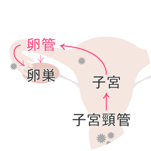 なんでクラミジアで不妊症に？