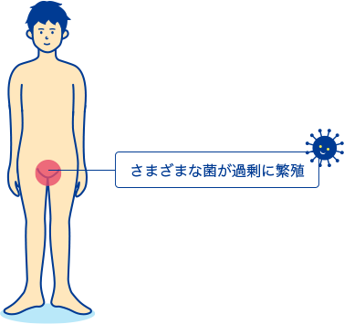 亀頭包皮炎の解説 症状や原因 治療について Std研究所