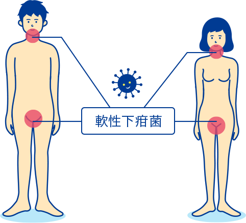 軟性下疳の解説 症状や感染経路 検査や治療について Std研究所