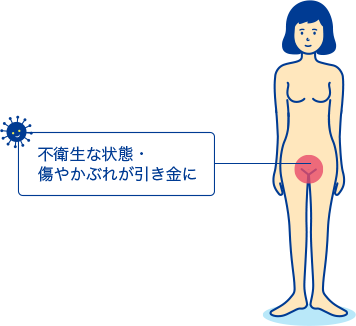 外陰炎の解説 症状や原因 治療について Std研究所